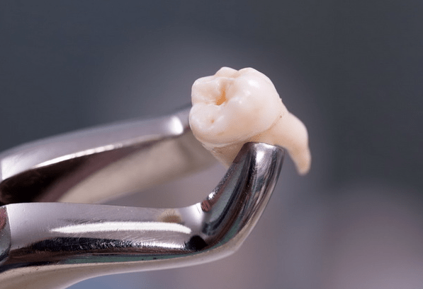 Хирургическое удаление зубов